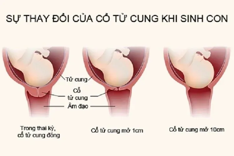 10 dấu hiệu chuyển dạ chính xác nhất các bà bầu nên biết