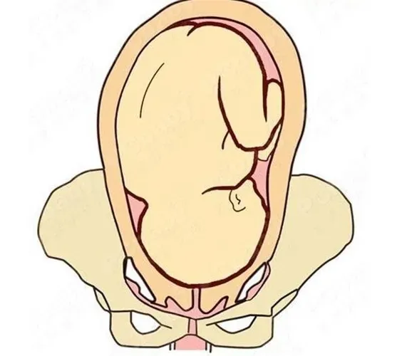 10 vị trí ngôi thai không thuận có thể được chỉ định sinh mổ