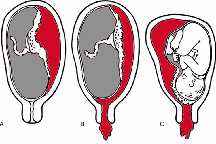 7 bất thường về nhau thai có thể gặp trong thai kỳ