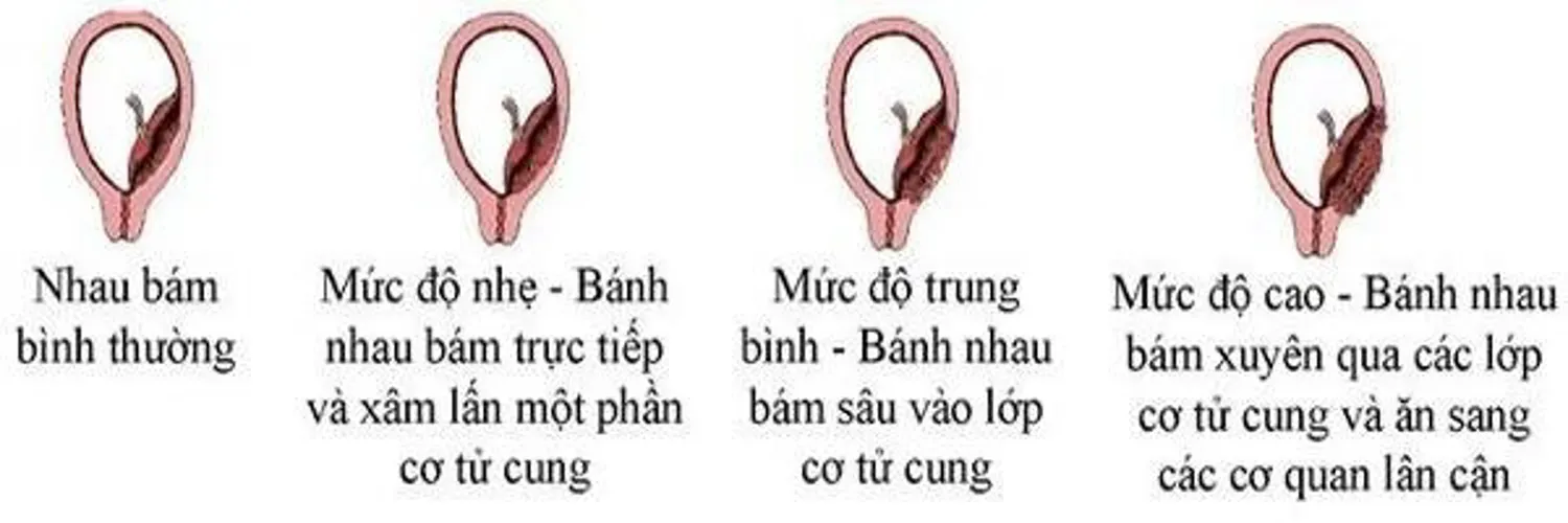 7 bất thường về nhau thai có thể gặp trong thai kỳ