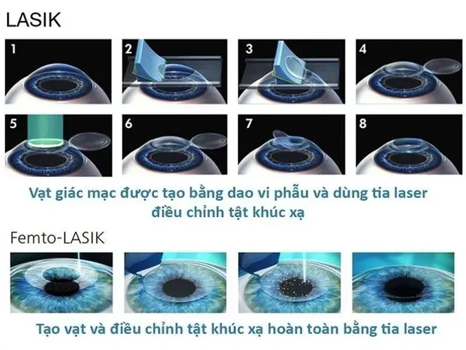 Bắn mắt cận thị là gì và dành cho những đối tượng nào?