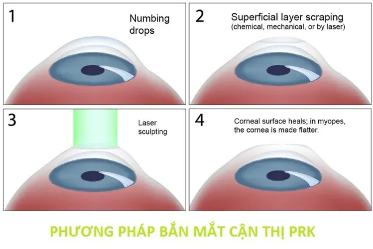 Bắn mắt cận thị là gì và dành cho những đối tượng nào?