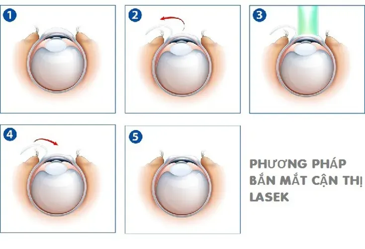 Bắn mắt cận thị là gì và dành cho những đối tượng nào?