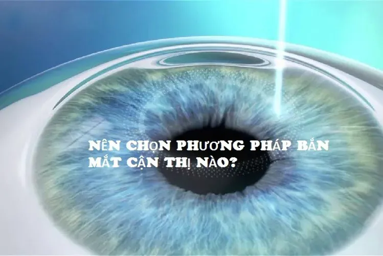 Bắn mắt cận thị là gì và dành cho những đối tượng nào?