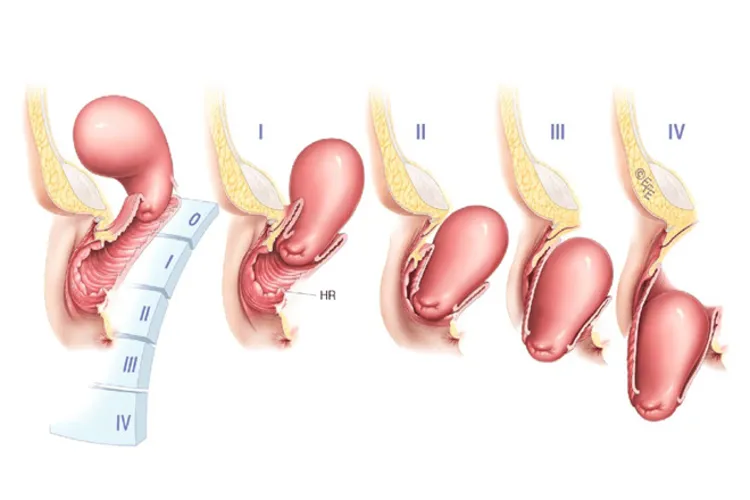 Băng huyết sau sinh và những điều liên quan mẹ cần biết