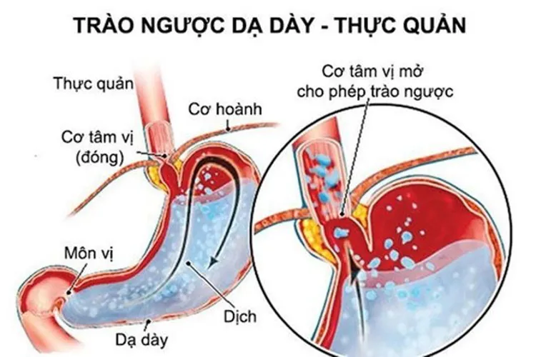 Bé bị trào ngược dạ dày có nguy hiểm không?