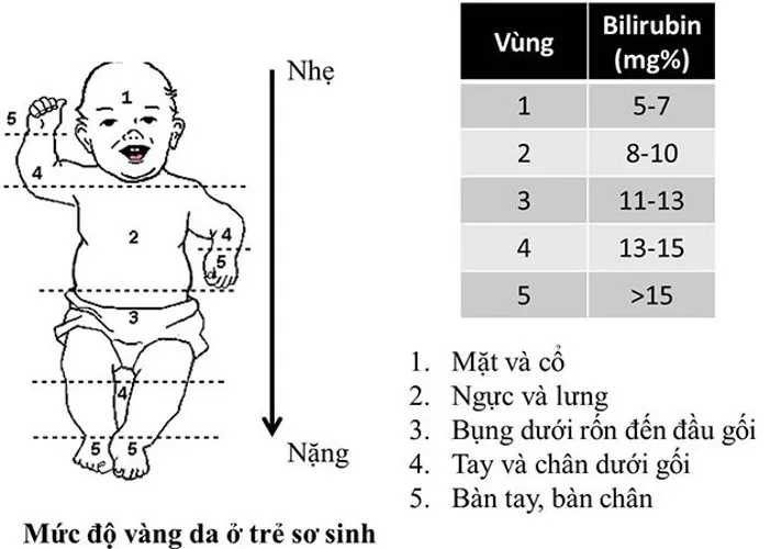 Bé bị vàng da và những điều cần biết để điều trị hiệu quả cho bé