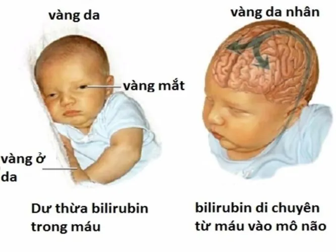 Bé bị vàng da và những điều cần biết để điều trị hiệu quả cho bé