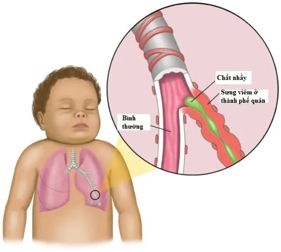 Bé ho có đờm và những điều mẹ cần biết để chăm sóc tốt cho bé