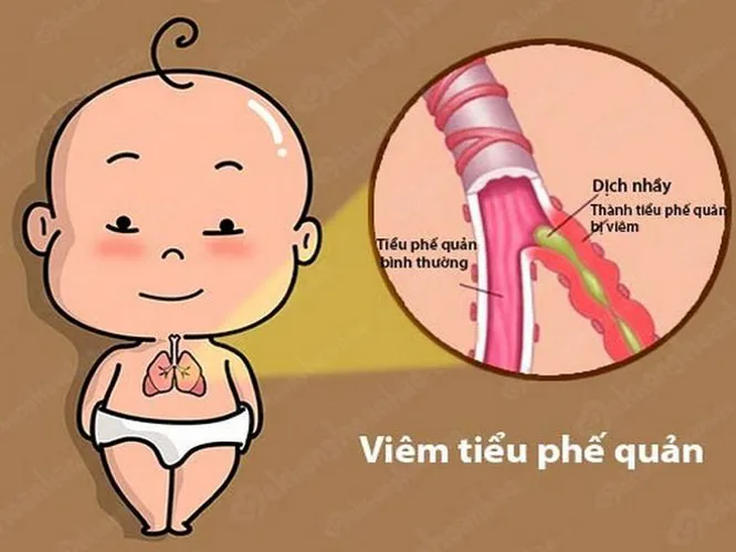 Bé sơ sinh thở khò khè, nguyên nhân và cách điều trị hiệu quả