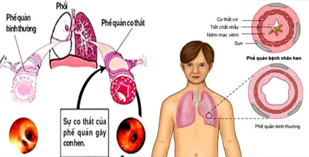 Bé sơ sinh thở khò khè, nguyên nhân và cách điều trị hiệu quả