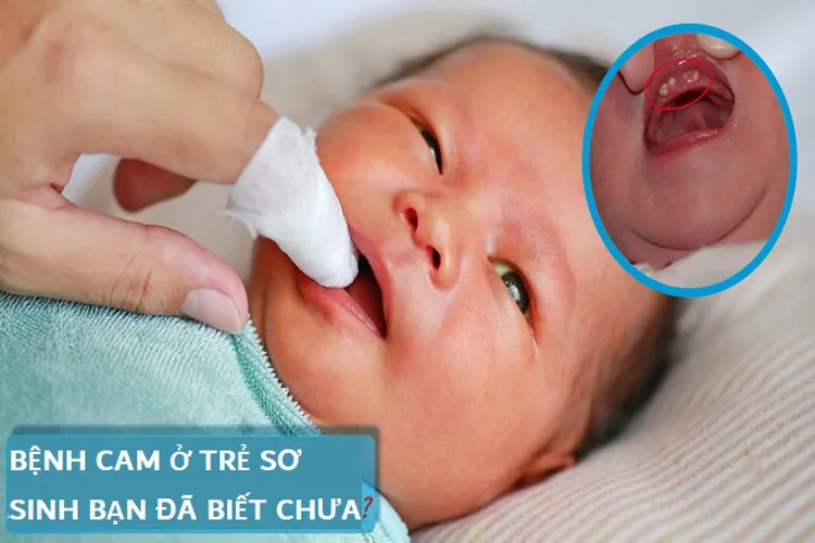 Bệnh cam ở trẻ sơ sinh – dấu hiệu, điều trị và cách phòng tránh hiệu quả