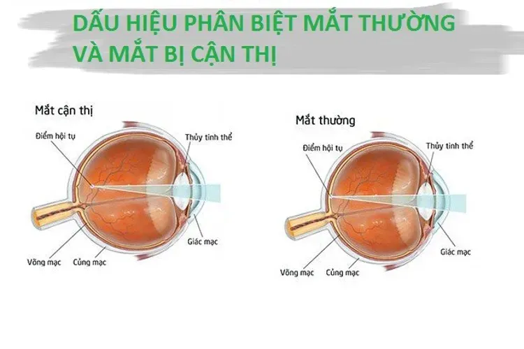 Bệnh cận thị ở trẻ em và những thông tin liên quan cha mẹ cần tham khảo