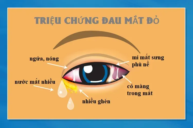 Bệnh đau mắt đỏ ở trẻ em và những điều cơ bản liên quan mẹ cần biết