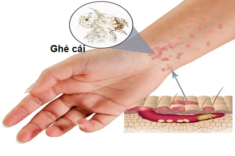 Bệnh ghẻ ở trẻ em – triệu chứng, nguyên nhân, cách phòng và điều trị