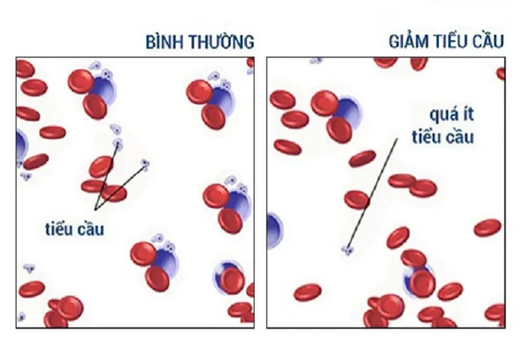 Bệnh giảm tiểu cầu ở trẻ em và những thông tin quan trọng liên quan mẹ cần biết