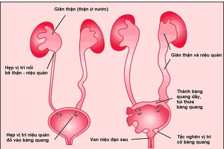 Bệnh giãn bể thận ở thai nhi và những điều mẹ cần biết để bảo vệ bé