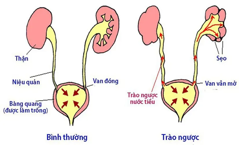 Bệnh giãn bể thận ở thai nhi và những điều mẹ cần biết để bảo vệ bé