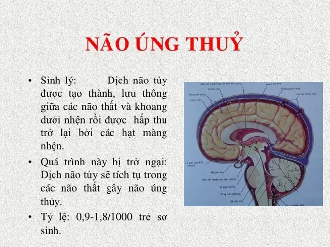 Bệnh giãn thất não ở trẻ sơ sinh nguy hiểm như thế nào?