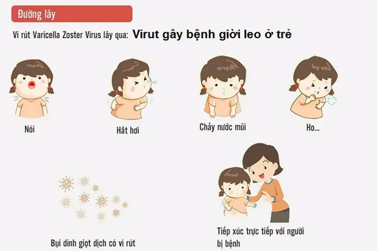 Bệnh giời leo ở trẻ em – nguyên nhân, cách điều trị và phòng tránh bệnh