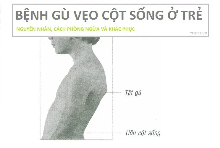 Bệnh gù vẹo cột sống ở trẻ – nguyên nhân, cách phòng ngừa và khắc phục tại nhà