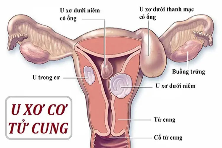 Bệnh nhân xơ tử cung là gì và những điều chị em phụ nữ cần biết