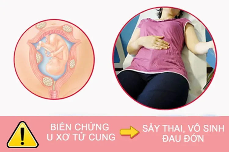 Bệnh nhân xơ tử cung là gì và những điều chị em phụ nữ cần biết