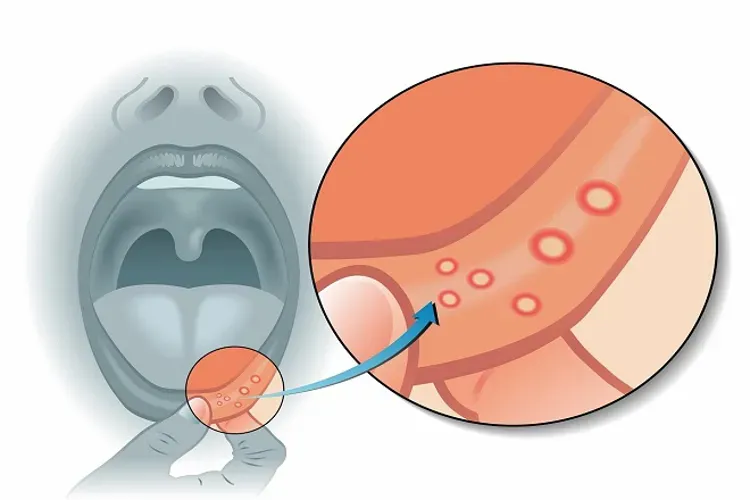 Bệnh nhiệt miệng ở trẻ em và mọi vấn đề liên quan bố mẹ nên biết