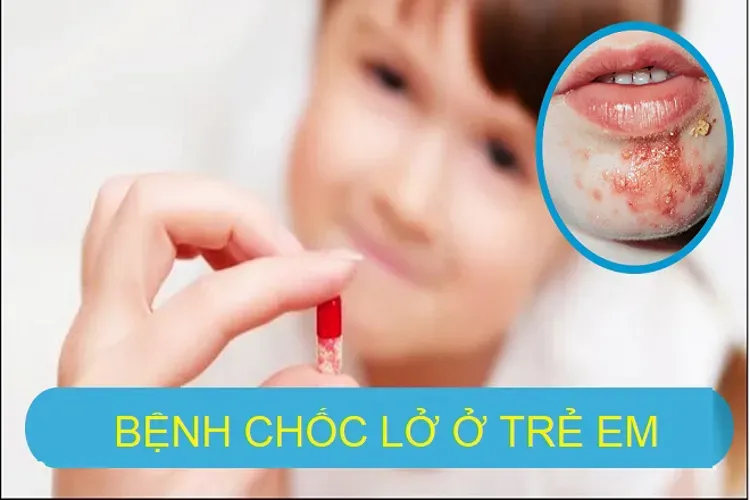 Bệnh ở trẻ em vào mùa hè – 4 nhóm bệnh thường gặp nhất định mẹ phải biết