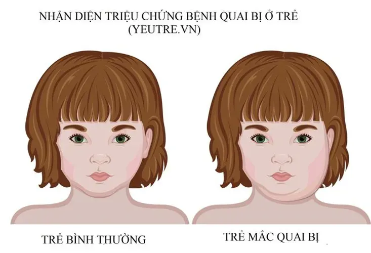 Bệnh quai bị ở trẻ em – triệu chứng, nguyên nhân và cách chữa trị hiệu quả