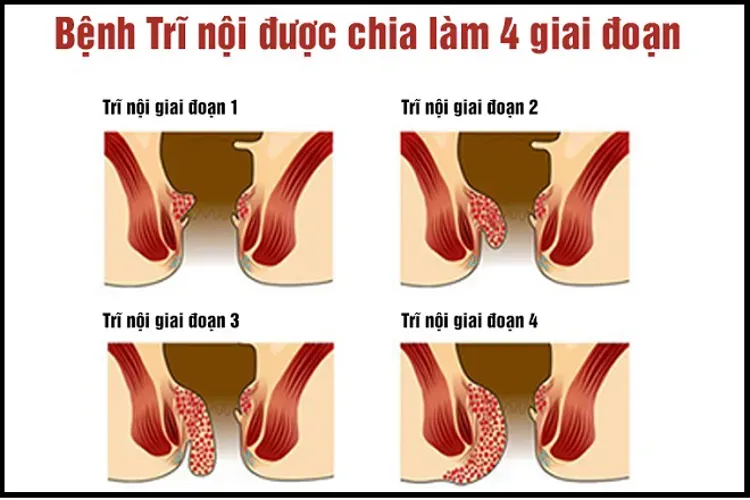 Bệnh trĩ khi mang thai và những điều mẹ bầu cần biết