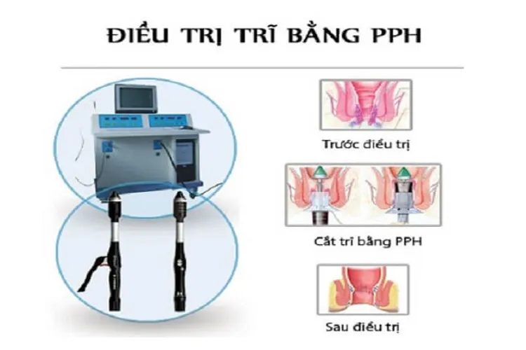 Bệnh trĩ sau sinh – nỗi ám ảnh của các mẹ mới sinh con