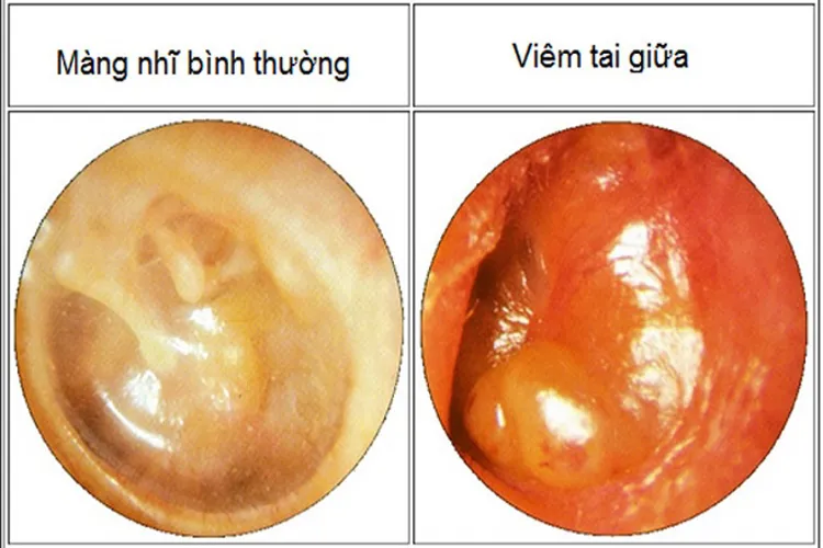 Bệnh viêm tai giữa ở trẻ sơ sinh và những điều mẹ cần biết