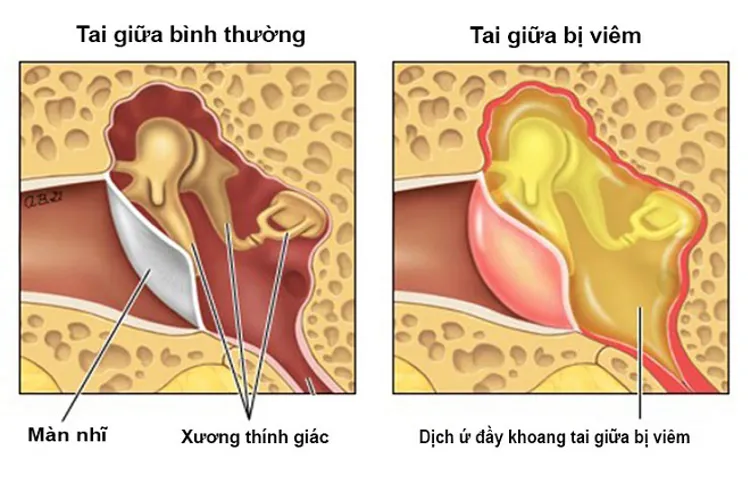 Bệnh viêm tai giữa ở trẻ sơ sinh và những điều mẹ cần biết