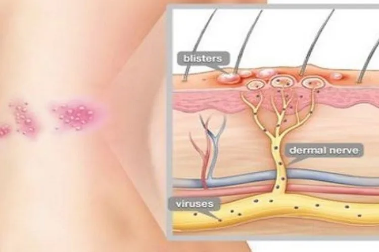 Bệnh zona có lây không và cách điều trị như thế nào?