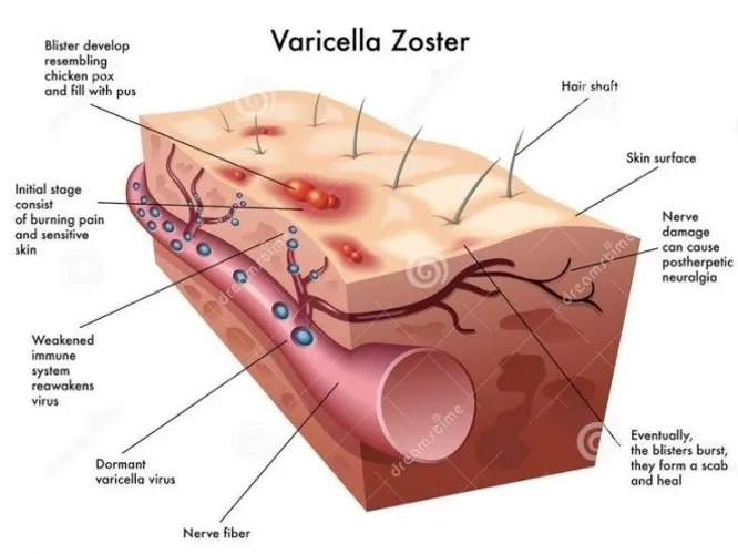 Bệnh zona là gì và những điều cần biết về bệnh zona