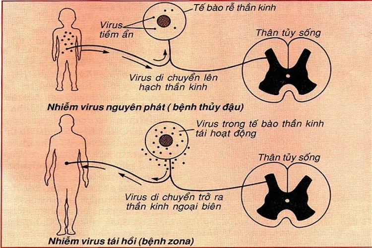 Bệnh zona ở trẻ em và những câu hỏi liên quan thường gặp nhất