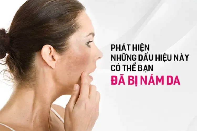 Bị nám da khi mang thai có hết không, làm sao để phòng ngừa?