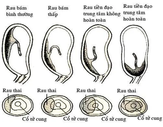 Bị nhau bám thấp mẹ bầu cần lưu ý gì?