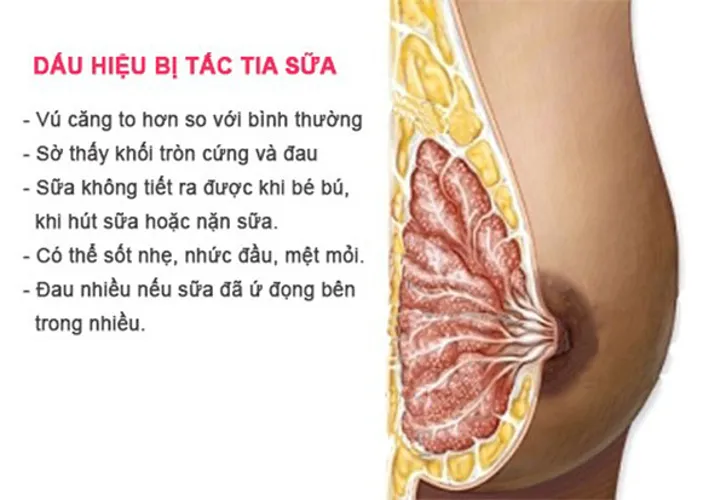 Bị tắc tia sữa – nỗi ám ảnh của mẹ sau sinh