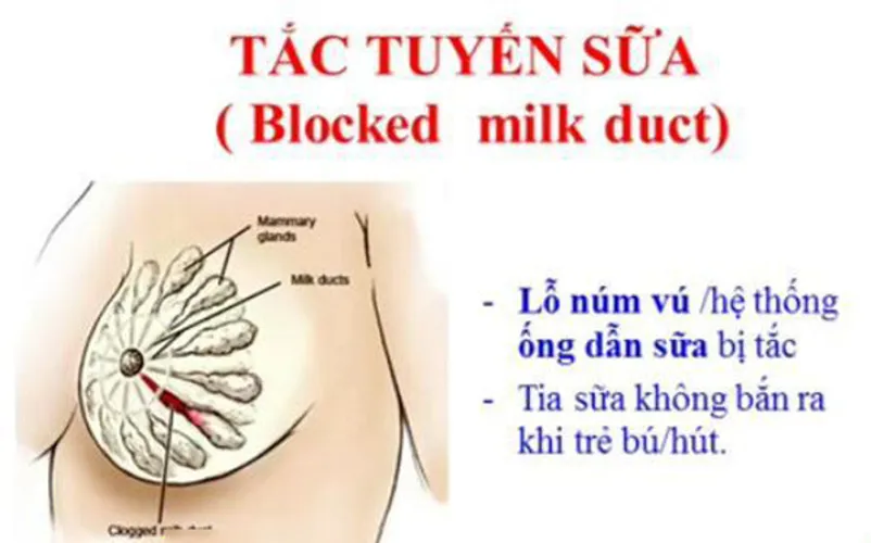 Bị tắc tia sữa – nỗi ám ảnh của mẹ sau sinh