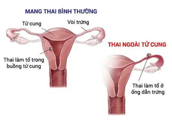 Bị thai ngoài tử cung có thể có con không và những điều liên quan chị em nào cũng cần biết