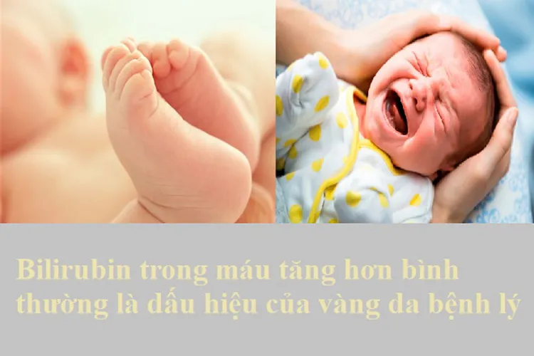 Biểu hiện vàng da bệnh lý ở trẻ sơ sinh và lời khuyên dành cho các mẹ