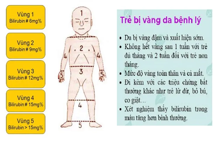 Biểu hiện vàng da bệnh lý ở trẻ sơ sinh và lời khuyên dành cho các mẹ