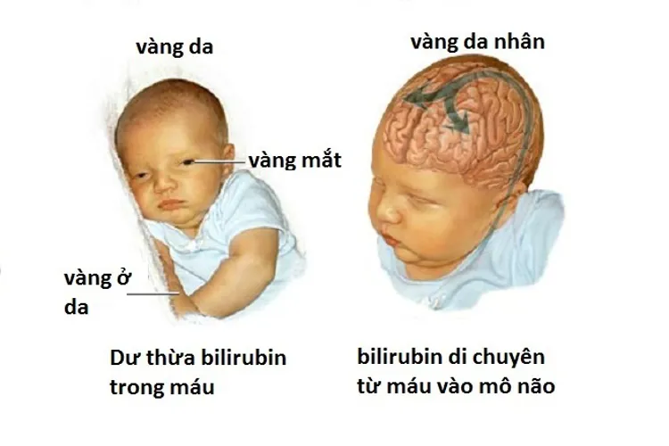 Biểu hiện vàng da bệnh lý ở trẻ sơ sinh và lời khuyên dành cho các mẹ