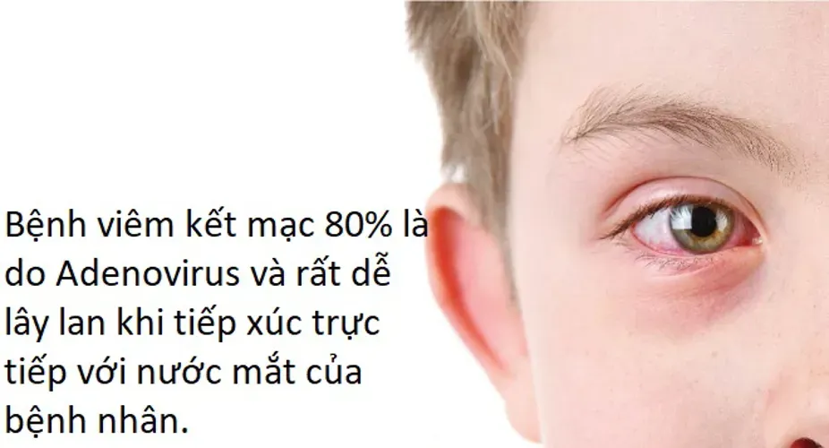 Các bệnh về mắt ở trẻ em – cách phòng ngừa và điều trị đúng cách