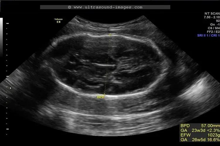 Các chỉ số siêu âm thai – mẹ cần nắm rõ để hiểu hơn về tình trạng của bé