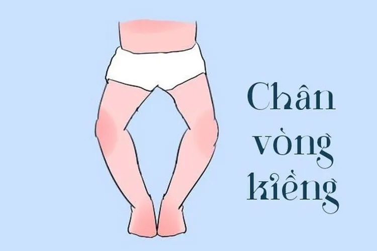 Cách chữa chân vòng kiềng cho bé – mẹ nên tìm hiểu