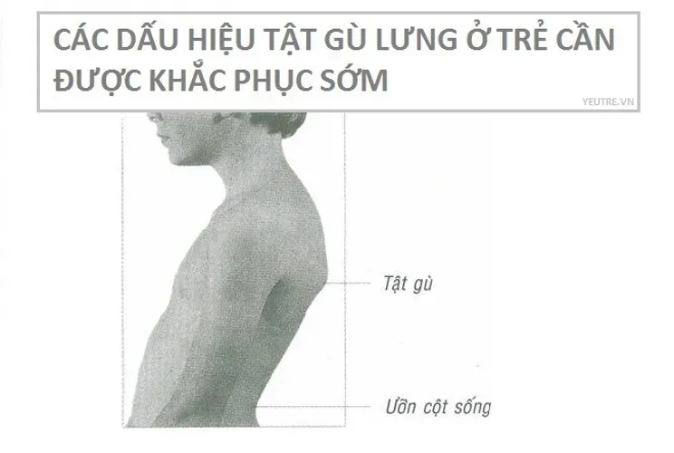 Cách khắc phục gù lưng hiệu quả cho mọi lứa tuổi