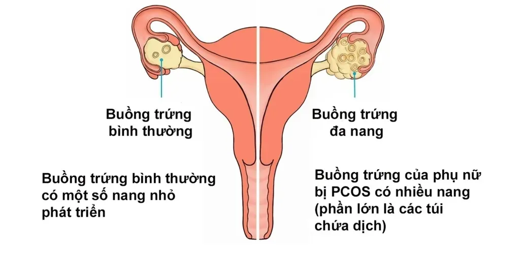 Cách thụ tinh nhân tạo bằng kỹ thuật nuôi trứng non trong ống nghiệm (IVM)